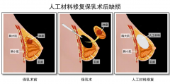 <b>乳房再造，帮助女人找回自信与尊严</b>