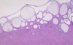 <b>子宫肌瘤怎么形成的，主要有哪些症状，发病原因不明</b>
