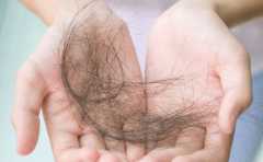 <b>油脂性脱发怎么办？人到中年油腻脱发遭嫌弃，分享改善方法</b>