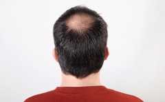 <b>人到中年脱发多，治疗脂溢性脱发有什么方法</b>