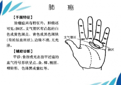 掌纹诊病 图谱，中医中的6种掌纹诊病图，一看就懂