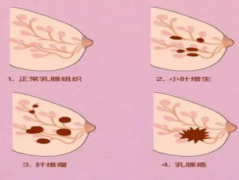 怎样摸出乳房有硬块图 出现乳房硬块的几种情况