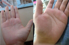 掌纹算命与诊病的联系，如何通过掌纹诊病？