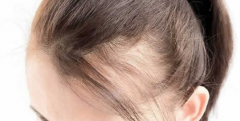 通过卵磷脂能治脱发吗 出现脱发都有哪些原因