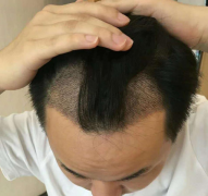 脂溢性脱发治疗方法 如何治疗脂溢性脱发呢