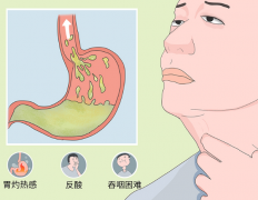 返流性食管炎的日常饮食食谱 消化道疾病的饮食