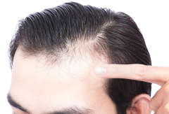 什么原因导致中年脱发，常见五点因素